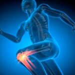 Menisküs Yırtığı Olanlar İçin Önemli Uyarı: Her Durumda Ameliyat Gerekmiyor